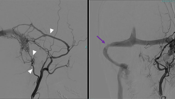 Too Much to Drain: Concurrent Dural AVF and Transverse Sinus Stenosis Causing IIH