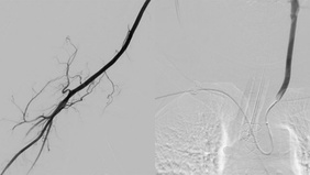 Two Sides, Two Strategies: Standalone versus Adjunctive MMA Embolization in Bilateral cSDH