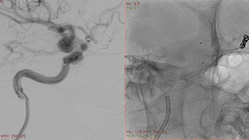 Wide-Neck Aneurysm embolization with Nautilus device