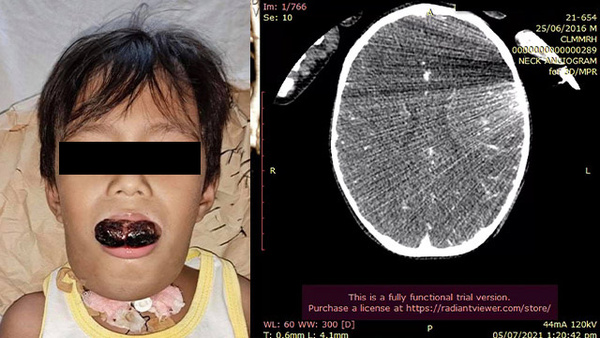 Lymphatic malformation of the tongue - Bleomycin sclerotherapy