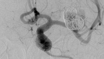 M1 left aneurysm