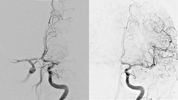M1 occlusion with persistent MeVO