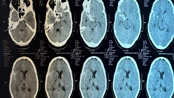 M1 segment thrombosed aneurysm - clipping or coiling? Role of vessel wall imaging