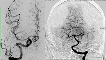 Management of complex CCF case