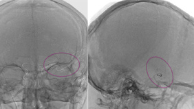 MCA Transcerebral Mechanical Thrombectomy