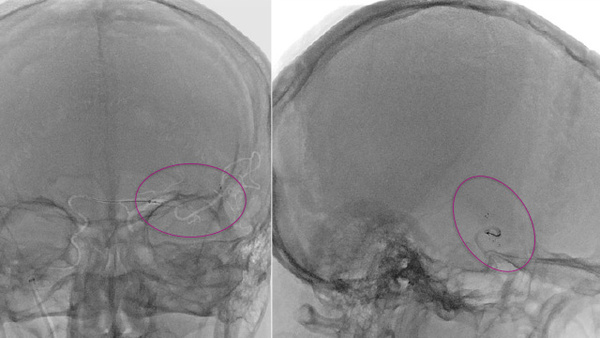 MCA Transcerebral Mechanical Thrombectomy