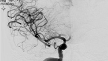 Mechanical thrombectomy in double occlusion stroke