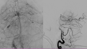 Mechanical Thrombectomy in Pontine Large Infarction