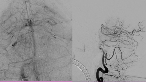 Mechanical Thrombectomy in Pontine Large Infarction