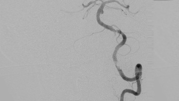 Mid basilar aneurysm treatment with unexpected evolution