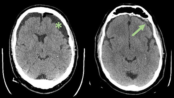 Middle Meningeal Artery Embolization for Recurrent Chronic Subdural Hematoma