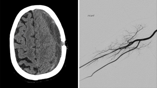 MMA embolization of a 79 year old patient