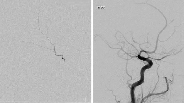 MMA embolization of a 96 year old patient 