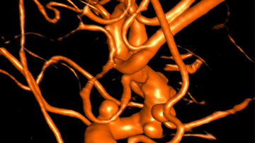 Multiple aneurysms on left ICA treated with Flow Diverter 