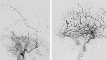 Multiple dural arteriovenous fistulas