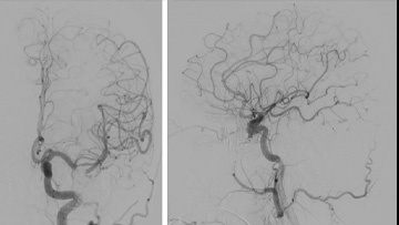 Multipouch intraosseous DAVF embolisation