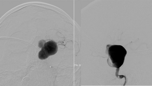 Mysterious Complication after Flow divertor-Giant Aneurysm