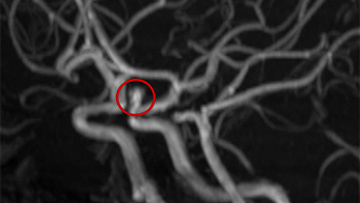 Ischemic stroke and cerebral vasospasm in a COVID-19 patient