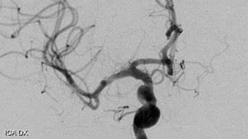 Pipeline™ Vantage Shield treatment with RIST™ radial system