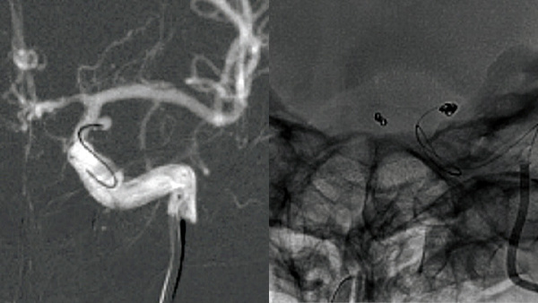 One&Done technique with optiMAX large volume coil