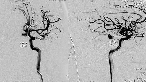 PCA aneurysm