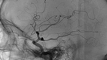 Pcom recurrence treated with multi-vessel reconstruction and coils