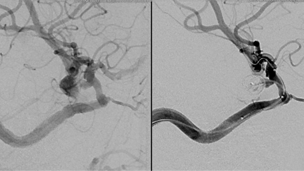 PCOM Rupture embolization with contemporary coil