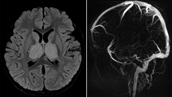 Pediatric deep cerebral vein thrombosis: a challenge case