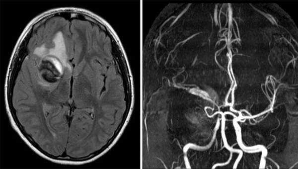 Pediatric ICA aneurysm 
