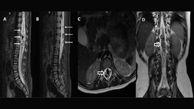 Perimedullary Arteriovenous Fistulae : A Detailed Case Report in a 6-month-old female
