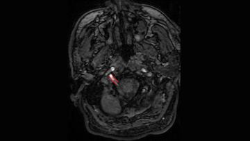 Persistent hypoglossal artery.