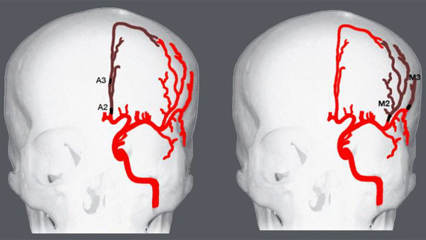 Pinch’ing the clot – solumbra technique for distal thrombectomies – are we there yet?