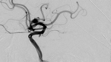 Pipeline-SHIELD-treatment-of-left-anterior-temporal-mid-M1-aneurysm 