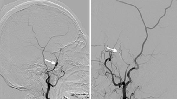 Post-traumatic bilateral pseudoaneurysms of the middle meningeal artery