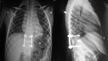 Pre-surgical embolization followed by decompression in atypical aggressive spinal hemangioma involving posterior elements