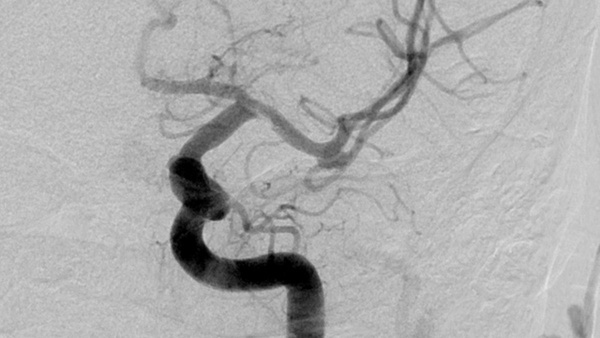 Predicting the unpredictable course of events after a Flow Diverter placement 