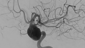Prolapsing flow diverter stent in a giant aneurysm