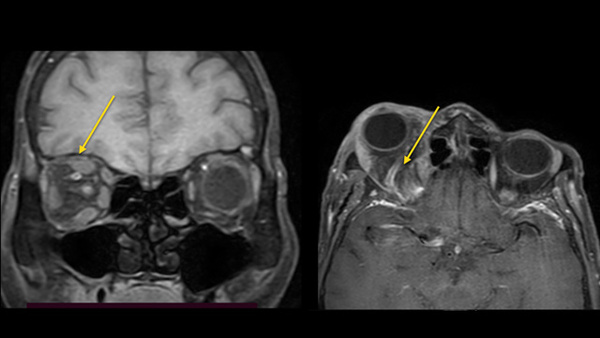 Proptosis? Eye’m on it: Paracavernous Fistula Embolization 