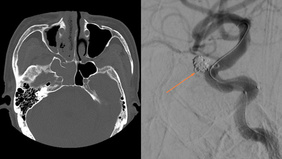 Pseudoaneurysm of the internal carotid artery due to sphenoid sinusitis