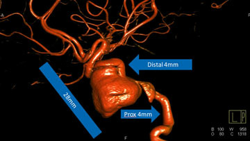 Pull-on-pipe maneuver for rescuing a prolapsed flow diverter 