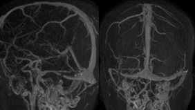 Pulsatile tinnitus - Whodunnit?