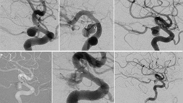 Rapidly growing PCOM-Aneurysm treated with the Contour Neurovascular System