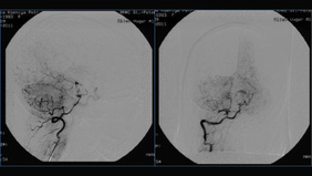 Rare case of uncomplicated delayed subocclusion of basilar artery after stent-assisted coil embolization of the giant partially thrombosed basilar tip aneurysm