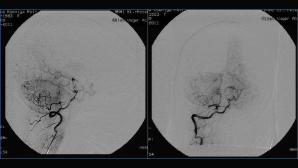 Rare case of uncomplicated delayed subocclusion of basilar artery after stent-assisted coil embolization of the giant partially thrombosed basilar tip aneurysm