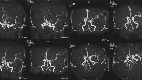 Recanalization of an ACM-CTO after 2 years of occlusion