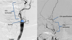Recanalization of symptomatic chronic ICA occlusion using Angioplasty, Stenting, and Rheolytic Thrombectomy