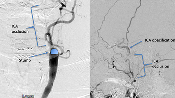 Recanalization of symptomatic chronic ICA occlusion using Angioplasty, Stenting, and Rheolytic Thrombectomy