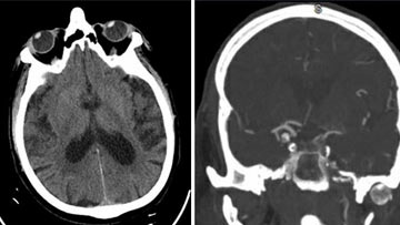 Recanalizing an acutely occluded, symptomatic, previously stented carotid artery