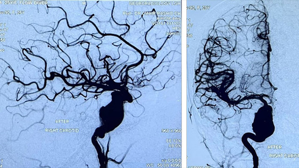 Recurrence of ICA aneurysm after flow diverter 