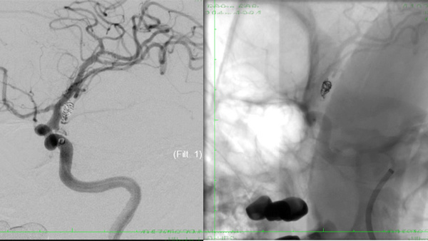 Recurrent malignant vasospasm in treated cases of intracranial ruptured aneurysms